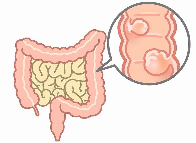 大腸ポリープ・大腸がん